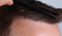 Before Hair Transplant&nbsp;Front